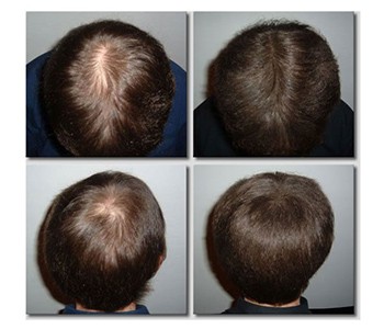 Плешивостта се увеличава с всеки изминал ден. Кой краде косата ви? Задължител...